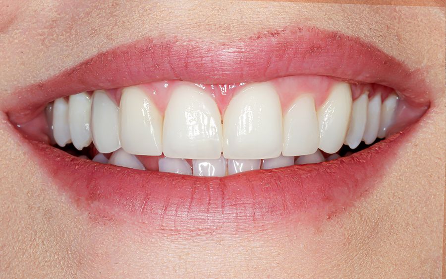 edge bonding gaps in teeth - after - 3dental